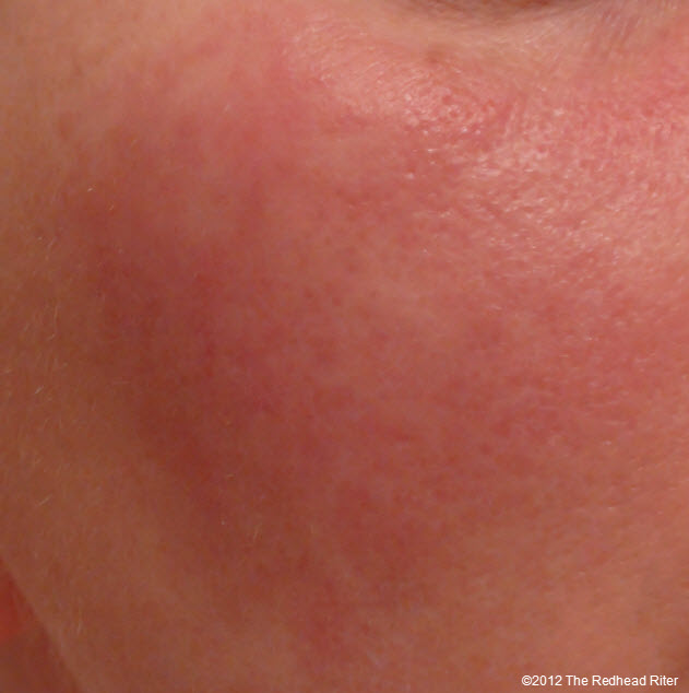 Grain Allergy Face Rash Swollen Bumps