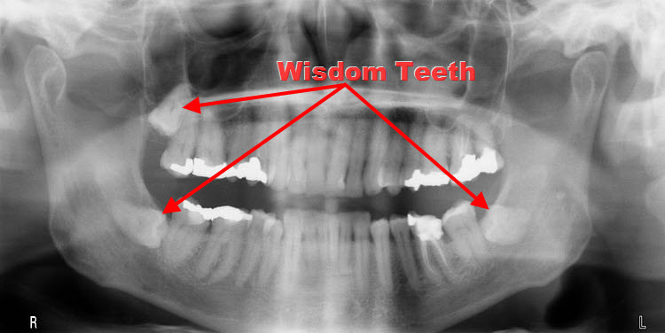 wisdom teeth full mouth dental xray