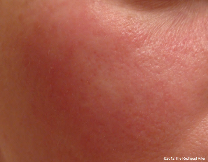 Gluten Rash On Face