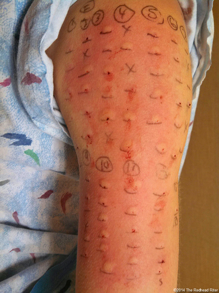food allergy skin prick test on arm
